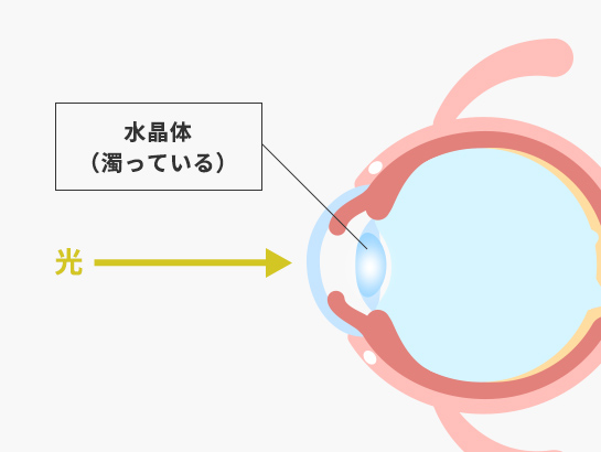 白内障の目