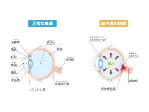 緑内障